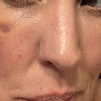 Aesthetic Artistry by Renee V - One week post procedure. Puffy under my eyes due to too much filler causing hollows underneath my eyes. Deep bruising. - Body Contouring Near Me - Roswell, New Mexico Aesthetic Artistry by Renee V - One week post procedure. Puffy under my eyes due to too much filler causing hollows underneath my eyes. Deep bruising. - Body Contouring Near Me - Roswell, New Mexico