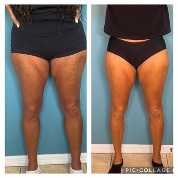 Cyn's Skincare - 6 treatments of before and after using laser lipo and Radio frequency ( Skin tightening ) - Skin Care Near Me - Tampa, Florida Cyn's Skincare - 6 treatments of before and after using laser lipo and Radio frequency ( Skin tightening ) - Skin Care Near Me - Tampa, Florida