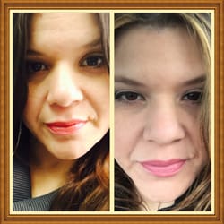 Cosmetic Medicine of Coral Gables - Before and After pictures of Botox on forehead. Thank you Cosmetic Medicine of Coral Gables!