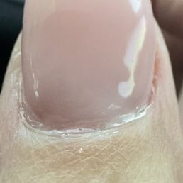 Lump on side Material on cuticle