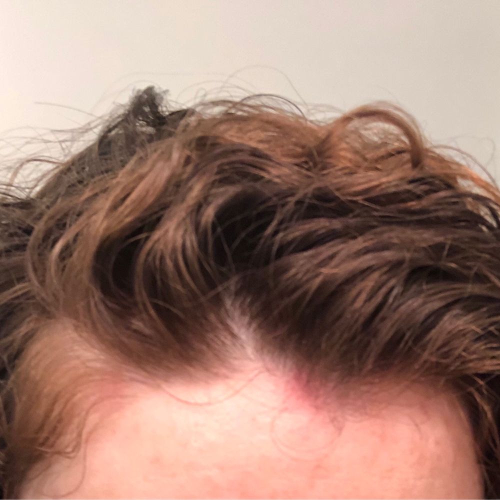 Salon Evolution - Red rash on scalp when she put on product. It hurt for days. - Hair Salons Near Me - Sagamore Beach, Massachusetts Salon Evolution - Red rash on scalp when she put on product. It hurt for days. - Hair Salons Near Me - Sagamore Beach, Massachusetts