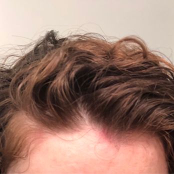 Salon Evolution - Red rash on scalp when she put on product. It hurt for days. - Hair Salons Near Me - Sagamore Beach, Massachusetts