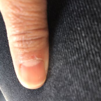 Allure Nails - Bad cuticles. Painful and peeling. - Nail Salons Near Me - Gaithersburg, Maryland Allure Nails - Bad cuticles. Painful and peeling. - Nail Salons Near Me - Gaithersburg, Maryland