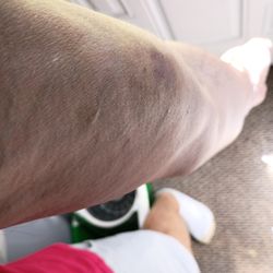 Starr Regional Medical Center - Athens - This is my arm almost a year later I am bleeding internally! To the evil big boned nurse with black hair you are a nasty human!!