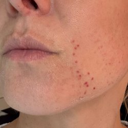 Najia's Skincare & Laser Center - Skin laser damage