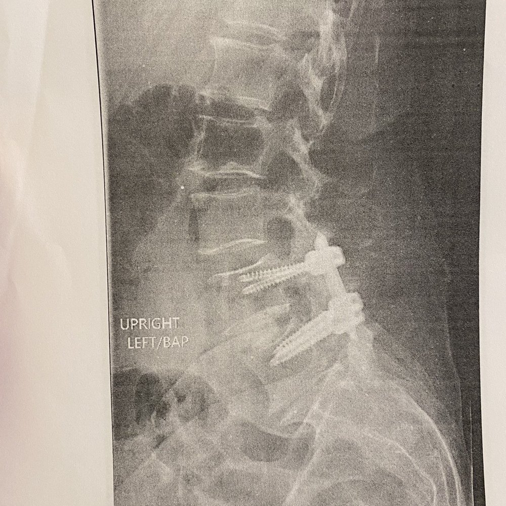 Spinal Xrays Spinal Xrays