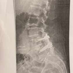 Jason Huffman, MD - Spinal Xrays