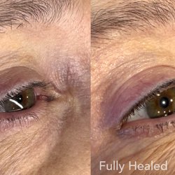 See the transformation: before and healed permanent eyeliner for beautifully defined eyes with a soft, effortless look every day.