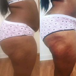 Fine and Fit Wellness - Instant results Lipo and Butt enhancement!!