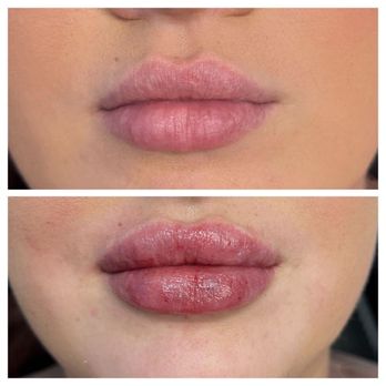 KC Wellness & Medspa - Lips / juvederm lip filler - Medical Spas Near Me - Riverview, Florida