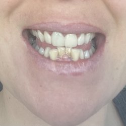 Crescent Prosthodontics - Before