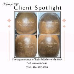 Kapenzo Hair - Hair restoration scalp Micropigmentation. Call 416-907-4333