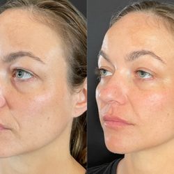 Jolene Aesthetics - Dermal filler to mid face, lips and smile lines