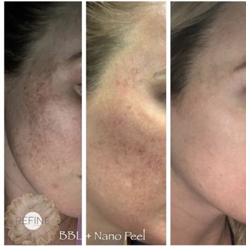 Refine MD Spa - Combination Therapy Treatment. Nano Peel + BBL. Post, healing and after a week. - Medical Spas Near Me - Bakersfield, California Refine MD Spa - Combination Therapy Treatment. Nano Peel + BBL. Post, healing and after a week. - Medical Spas Near Me - Bakersfield, California