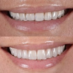 Beverly Hills Dentistry - Natural Smile Design for our lovely patient