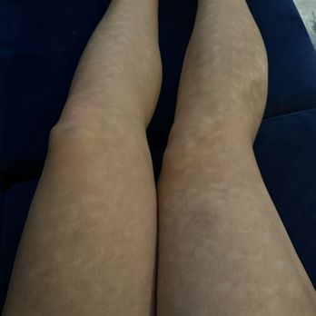 Milan Laser Hair Removal - How my legs will look like for the rest of my life... - Laser Hair Removal Near Me - Durham, North Carolina