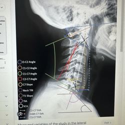 Infinite Body Health - Researching Cervical Spine measurements and methods.