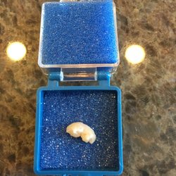 Apple Tree Dental - This is the piece of wisdom tooth Dr Sessions removed. Such a small piece an cause so much pain. But now I'm pain free!