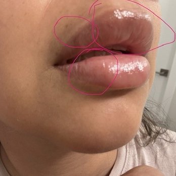 LaserAway - Lip filler hard and soft bumps - Tattoo Removal Near Me - Tysons, Virginia