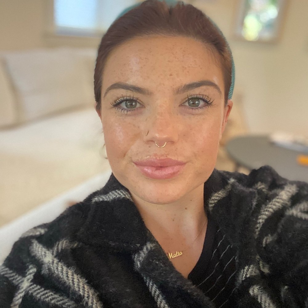 Conderman Facial Plastic Surgery - So happy with my Botox and Lip Filler by Dr.Conderman - Plastic Surgeons Near Me - Orinda, California Conderman Facial Plastic Surgery - So happy with my Botox and Lip Filler by Dr.Conderman - Plastic Surgeons Near Me - Orinda, California