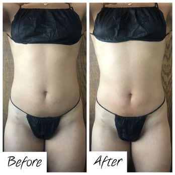 Bare Body Sculpting - Before & After: One hour session of ultrasonic cavitation, radio frequency skin tightening and wood therapy - Body Contouring Near Me - Santa Barbara, California Bare Body Sculpting - Before & After: One hour session of ultrasonic cavitation, radio frequency skin tightening and wood therapy - Body Contouring Near Me - Santa Barbara, California