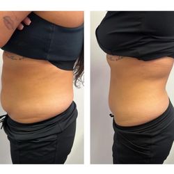 1 Stop Beauty Bar - Montebello  - Before and after pics from 1st to 4th session