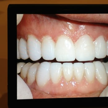 Michael J Mango, DDS - After Veneers - General Dentistry Near Me - Greensboro, North Carolina Michael J Mango, DDS - After Veneers - General Dentistry Near Me - Greensboro, North Carolina