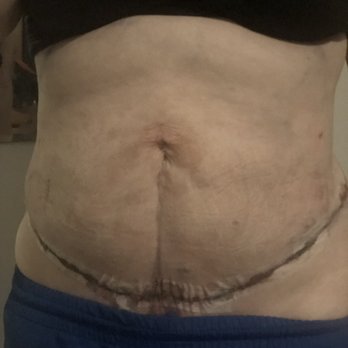 Sono Bello - After - Cosmetic Surgeons Near Me - San Antonio, Texas Sono Bello - After - Cosmetic Surgeons Near Me - San Antonio, Texas