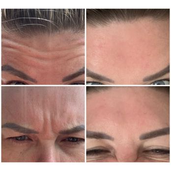 Wellness 2 You - #beforeandafter #letybo #koreanbotox #cheaperthanbotox - Concierge Medicine Near Me - Royersford, Pennsylvania Wellness 2 You - #beforeandafter #letybo #koreanbotox #cheaperthanbotox - Concierge Medicine Near Me - Royersford, Pennsylvania