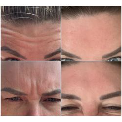 Wellness 2 You - #beforeandafter #letybo #koreanbotox #cheaperthanbotox