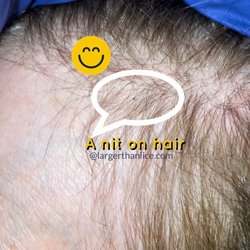 Larger Than Lice New York | Lice Treatment & Nit Removal Service - Here's what a nit looks like in the hair.