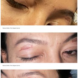 Natural Nails: first degree burns Natural Nails: first degree burns