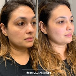 Beauty Lush Medspa - Dark Circle PRP Treatment