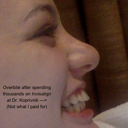 Sold me Invisalign that didn't work...
