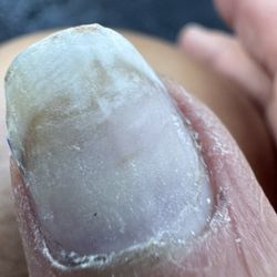 Ultimate Nails Spa - Fungal nail infections