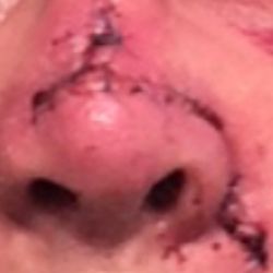 Carson Dermatology - About a week post-op (different MD), after the "negative" biopsy.