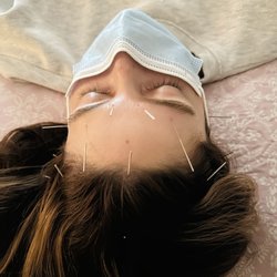 Eva Z Acupuncture - Acupuncture help with Migraine headaches