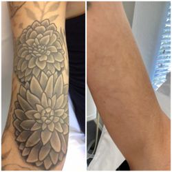 MEDermis Tattoo Removal  - Before and after 10 laser treatments