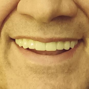 JSB Dental Lab - These are the completely believable, correctly-sized, comfortable and functional teeth I got from a GOOD LAB. - Orthodontists Near Me - Chicago, Illinois