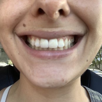 Advance Dental Studio - front teeth crowns - Cosmetic Dentists Near Me - Los Angeles, California