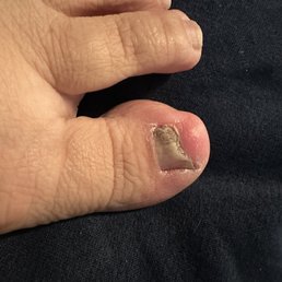 Infected toe Infected toe