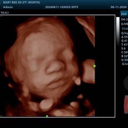 Baby Bee 3D Ultrasound
