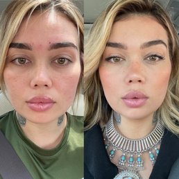 Before and after Botox PDO THREADS AND MINI LIP Before and after Botox PDO THREADS AND MINI LIP