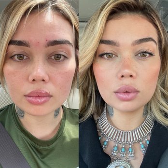 Alchemy Med Spa - Before and after Botox PDO THREADS AND MINI LIP - Medical Spas Near Me - Houston, Texas Alchemy Med Spa - Before and after Botox PDO THREADS AND MINI LIP - Medical Spas Near Me - Houston, Texas