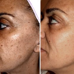 Club Skin Gym - Pigmentation Peel is no match for brown spots !