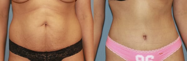 Tummy Tuck - If you have loose muscles, hanging skin, or excess fat in the stomach region, Beverly Hills plastic surgeon Dr. Eugene Kim might suggest a tummy tuck to help you achieve the look you desire. The tummy tuck, or abdominoplasty, is a popular body contouring procedure that works to gently reshape the stomach area through a tightening of the abdominal muscles. Tummy Tuck - If you have loose muscles, hanging skin, or excess fat in the stomach region, Beverly Hills plastic surgeon Dr. Eugene Kim might suggest a tummy tuck to help you achieve the look you desire. The tummy tuck, or abdominoplasty, is a popular body contouring procedure that works to gently reshape the stomach area through a tightening of the abdominal muscles.