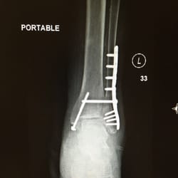 Lower Limb Institute: Mina Abadeer, DPM - Ankle fracture