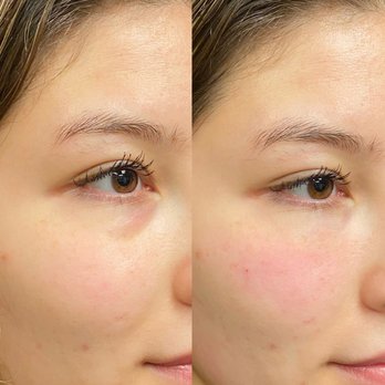 RAE Aesthetics - Signature Undereye Refresh - Skin Care Near Me - Columbia, Maryland RAE Aesthetics - Signature Undereye Refresh - Skin Care Near Me - Columbia, Maryland