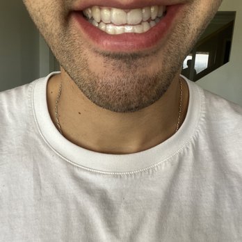 CaliSmile Orthodontics - Month 7 of Invisalign - Orthodontists Near Me - West Hills, California