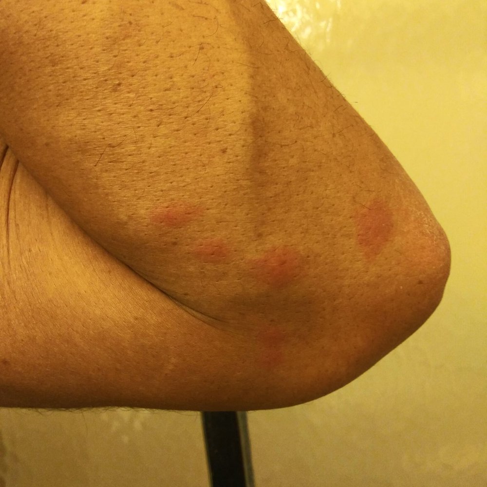 Oak Crest Motel - Bed bug bites - Hotels Near Me - Adams, Wisconsin Oak Crest Motel - Bed bug bites - Hotels Near Me - Adams, Wisconsin